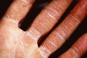 Eczema Spray: Your Path to Natural and Effective Skin Relief