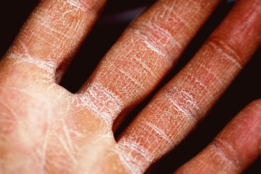 Eczema Spray: Your Path to Natural and Effective Skin Relief