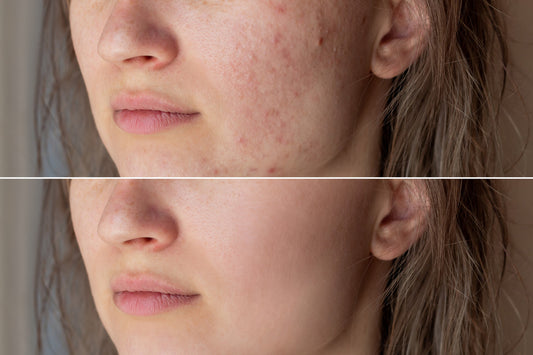 Does Sea Salt Spray for Acne Help?
